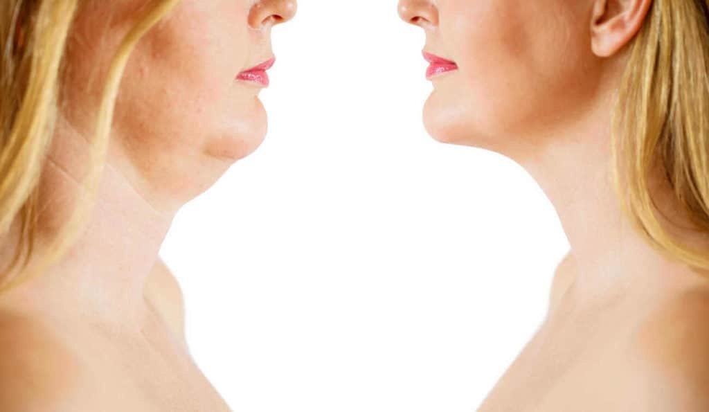 Double Chin treatment Wincanton before and after results