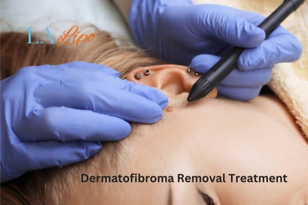 Dermatofibroma Removal Treatment Wincanton