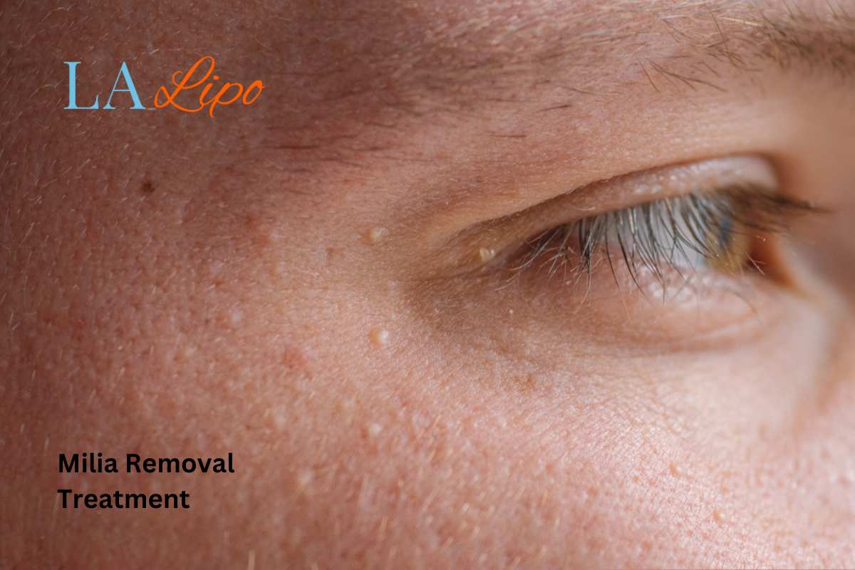 Cryopen Milia Removal: Is It the Easiest and Safest Option Wincanton?