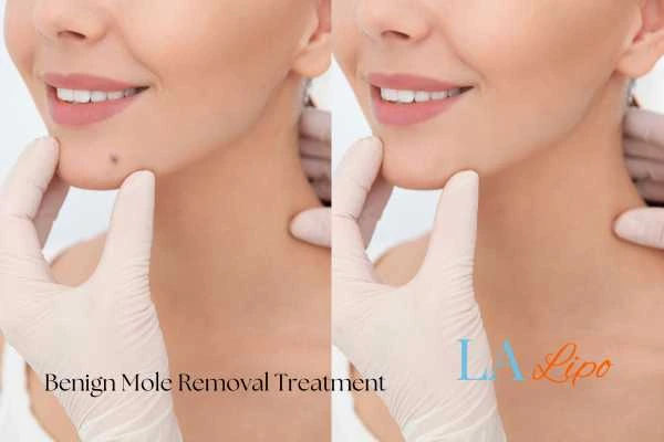 woman's before and after mole removal Wincanton results