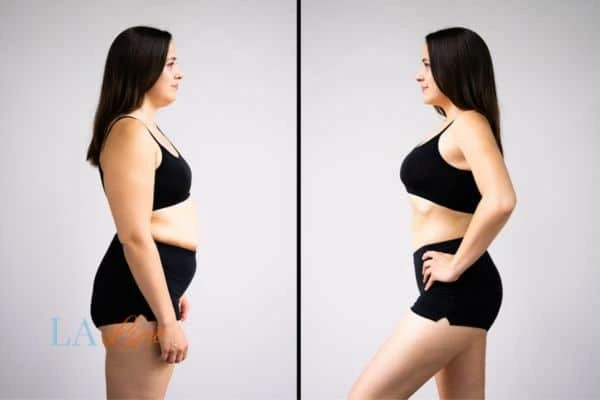 image of woman before and after results of LA-EMS Body Sculpting Wincanton to help treat Diastasis recti