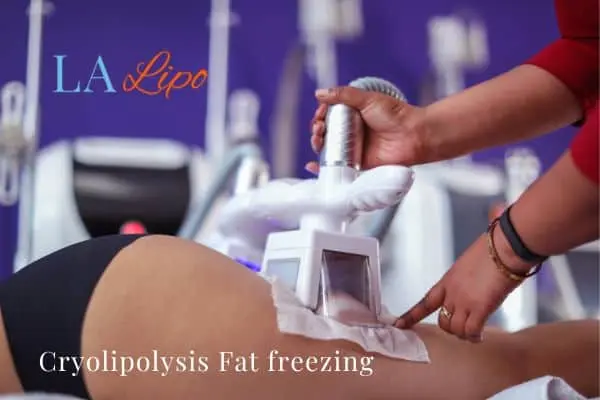 women getting fat freezing Wincanton