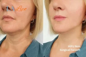 hi-fu for wrinkles Wincanton before and after results