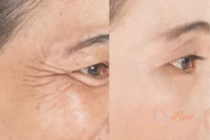 Before and after results of woman - HI-fu wrinkles reduction treatment Wincanton