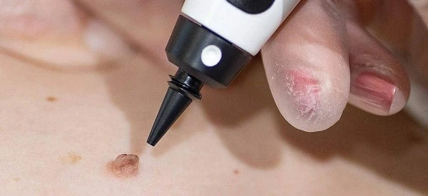 skin tag removal using cryopen Wincanton