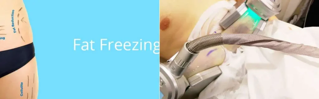 Fat freezing Wincanton on multiple areas of the body