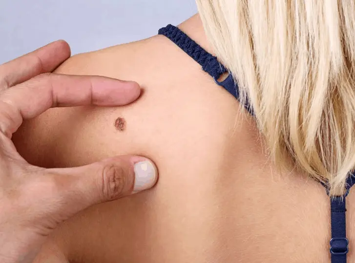 woman having mole removal Wincanton consultation before treatment.