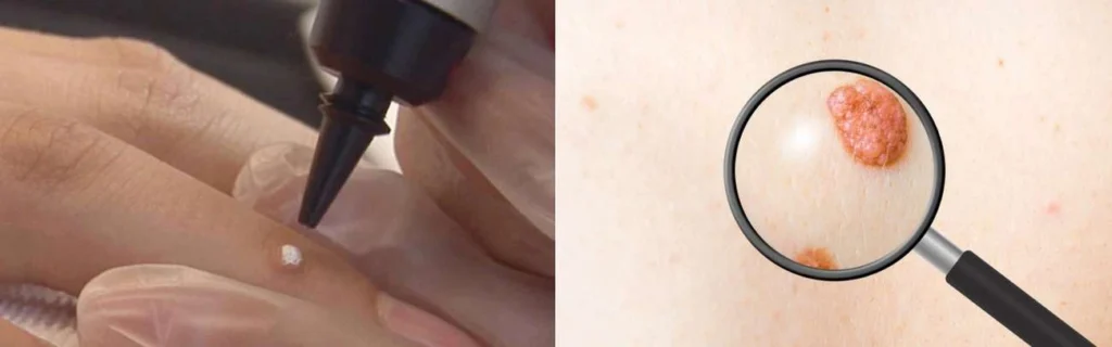 CryoPen practitioner Wincanton assessing a benign mole before treatment