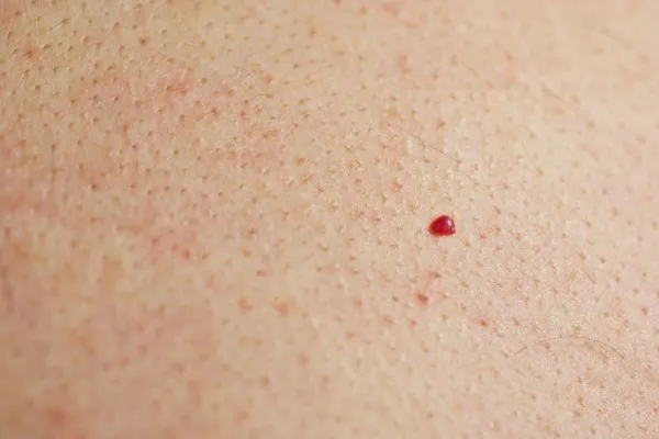 close up of a cherry angioma Wincanton