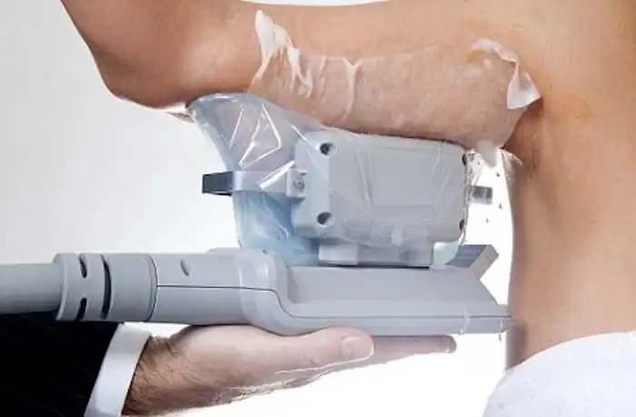 Picture of fat freezing Wincanton on the upper arms.