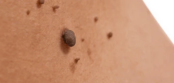 image of a skin tag Wincanton