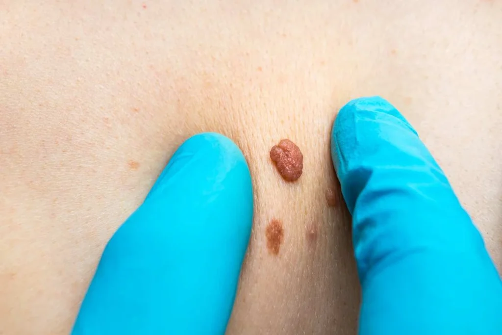 Consultant examining a skin tag Wincanton