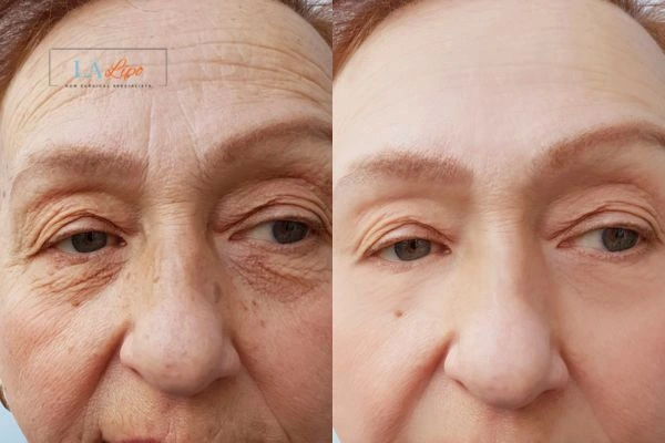 The powerful benefits of Morpheus8 Treatment Wincanton - Call Our team today!