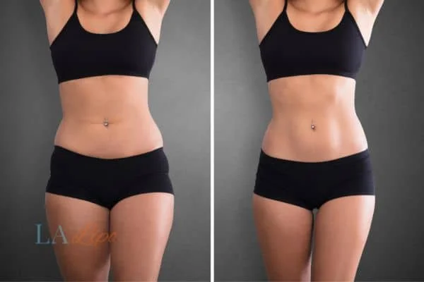 before and after results of non-surgical treatment to help a woman's body image and mental health Wincanton