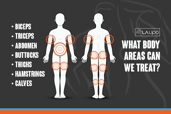 Diagram to show areas you can have LA-EMS Body Sculpting Treatment Wincanton