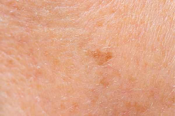 close up picture of age spots Wincanton