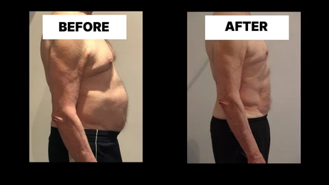 What Symptoms Can Diastasis Recti Cause in Men? Weak Core, Back Pain and Poor Posture Wincanton